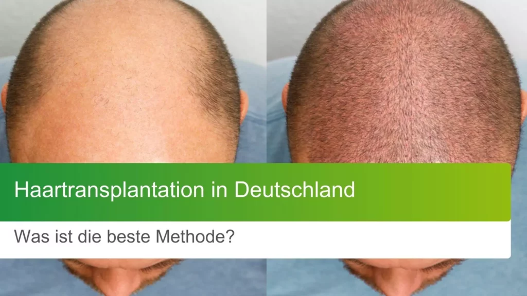 Haartransplantation in Deutschland